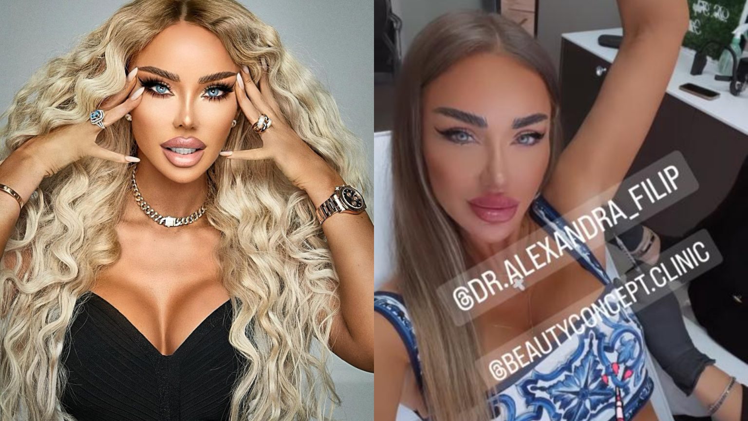 Bianca Drăgușanu, o nouă intervenție estetică, în zona axilei! Motivul pentru care diva a recurs la acest gest