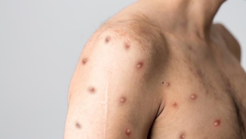 Noi cazuri de variola maimuței au fost confirmate în România. La cât a urcat bilanțul total