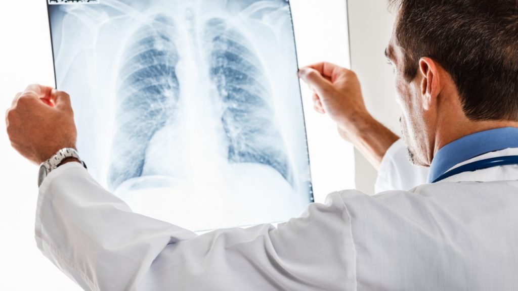 Studiu îngrijorător! S-a descoperit acum: Așa apare cancerul pulmonar! Cu toții suntem în pericol