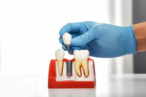 Implantul dentar, soluţia rapidă în redobândirea funcţionalităţii cavităţii orale